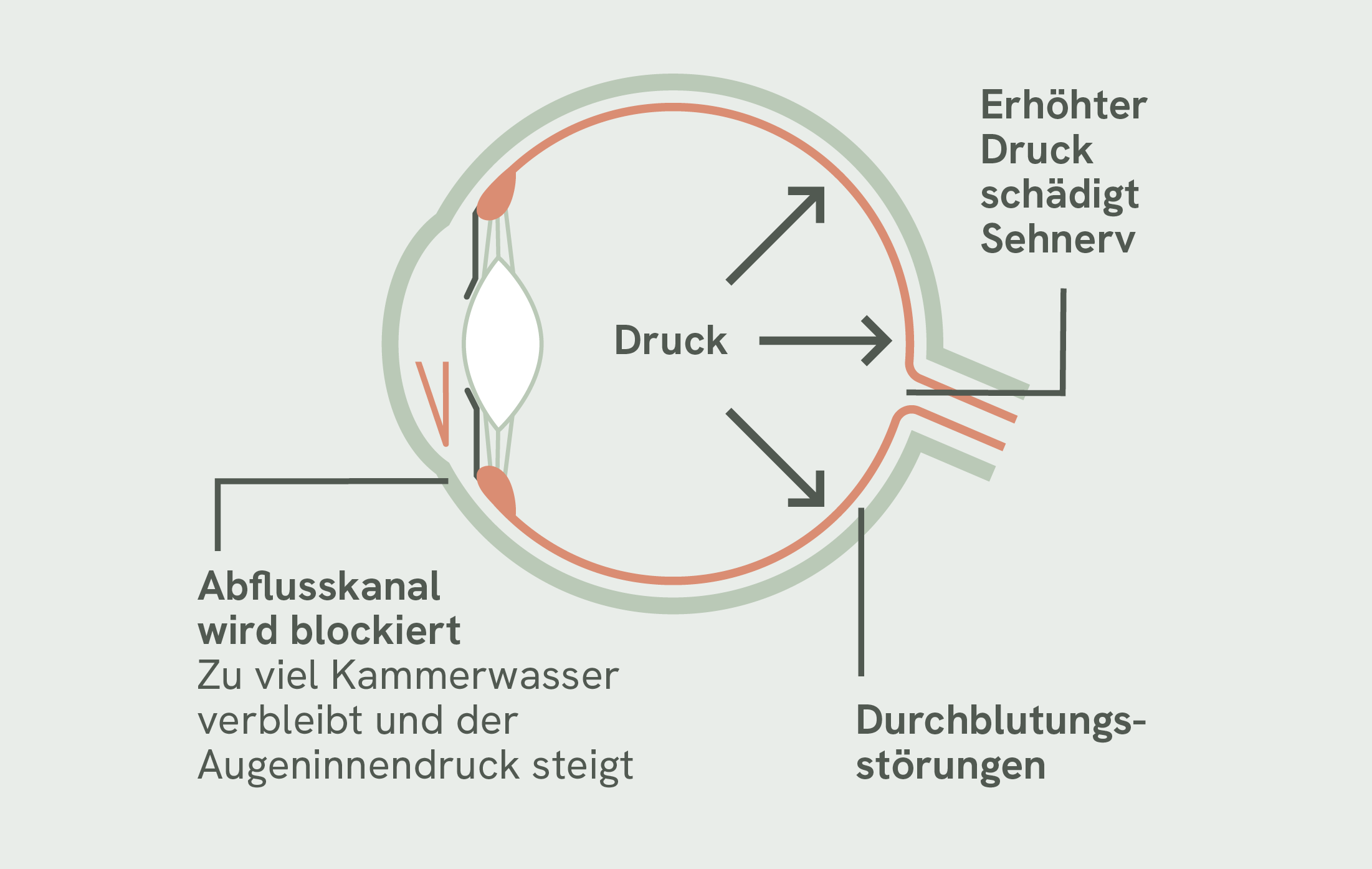 Glaukom, Grüner Star, Augenschema, Yuvis