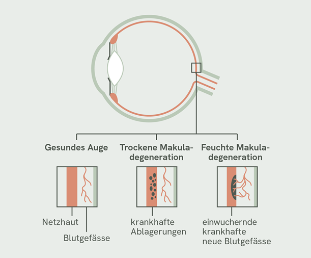 Makuladegeneration, AMD, Augenschema, Yuvis