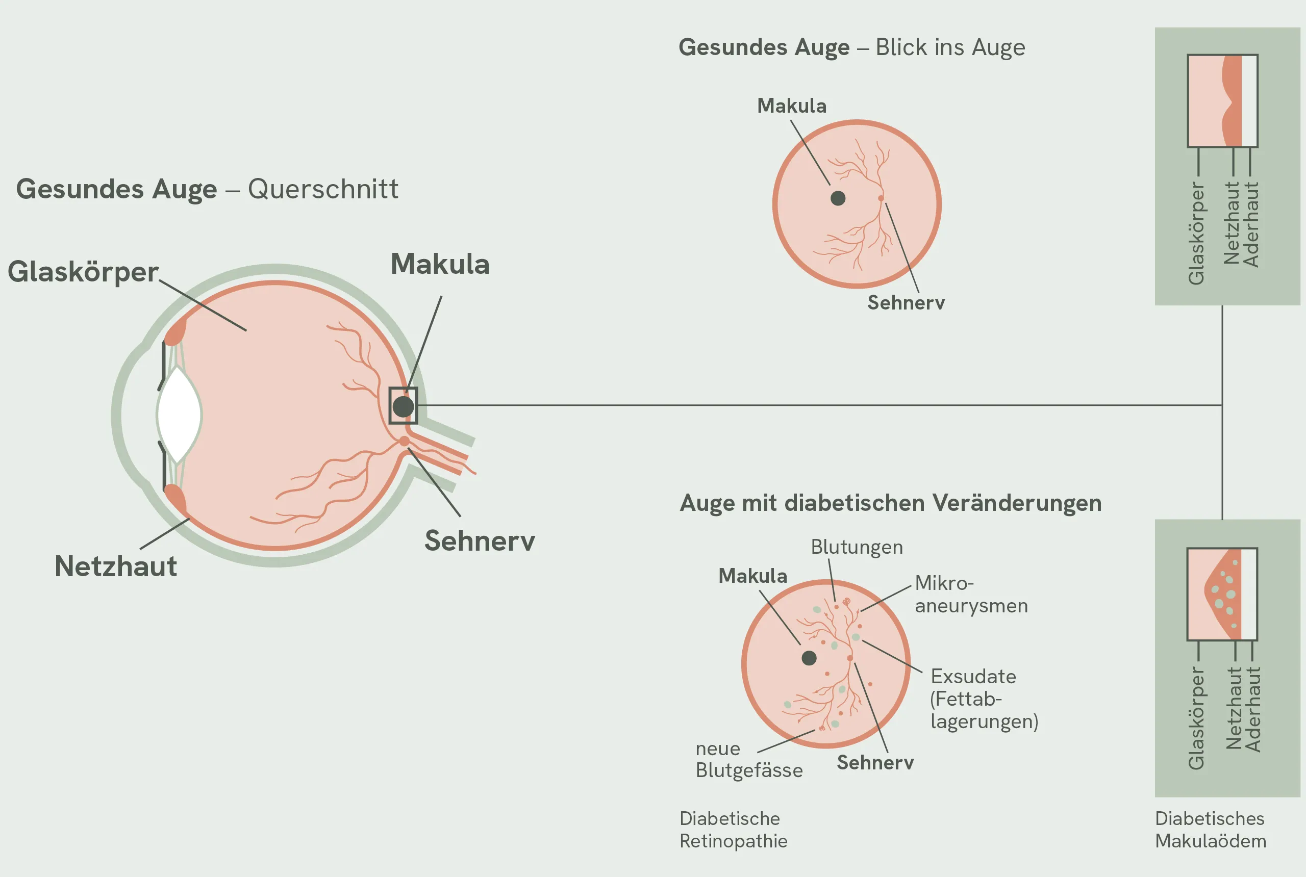 Diabetische Retinopathie Schema