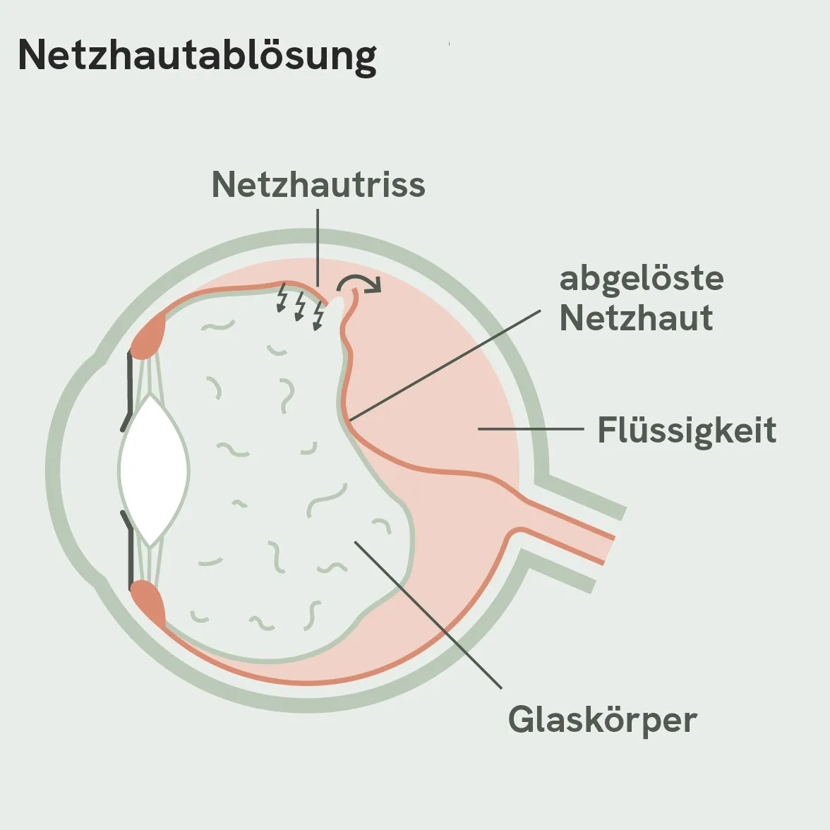 Netzhausablösung