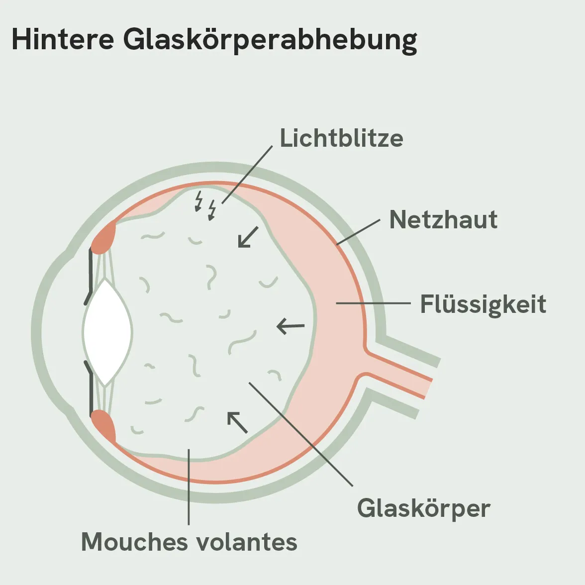 Hintere Glaskörperabhebung