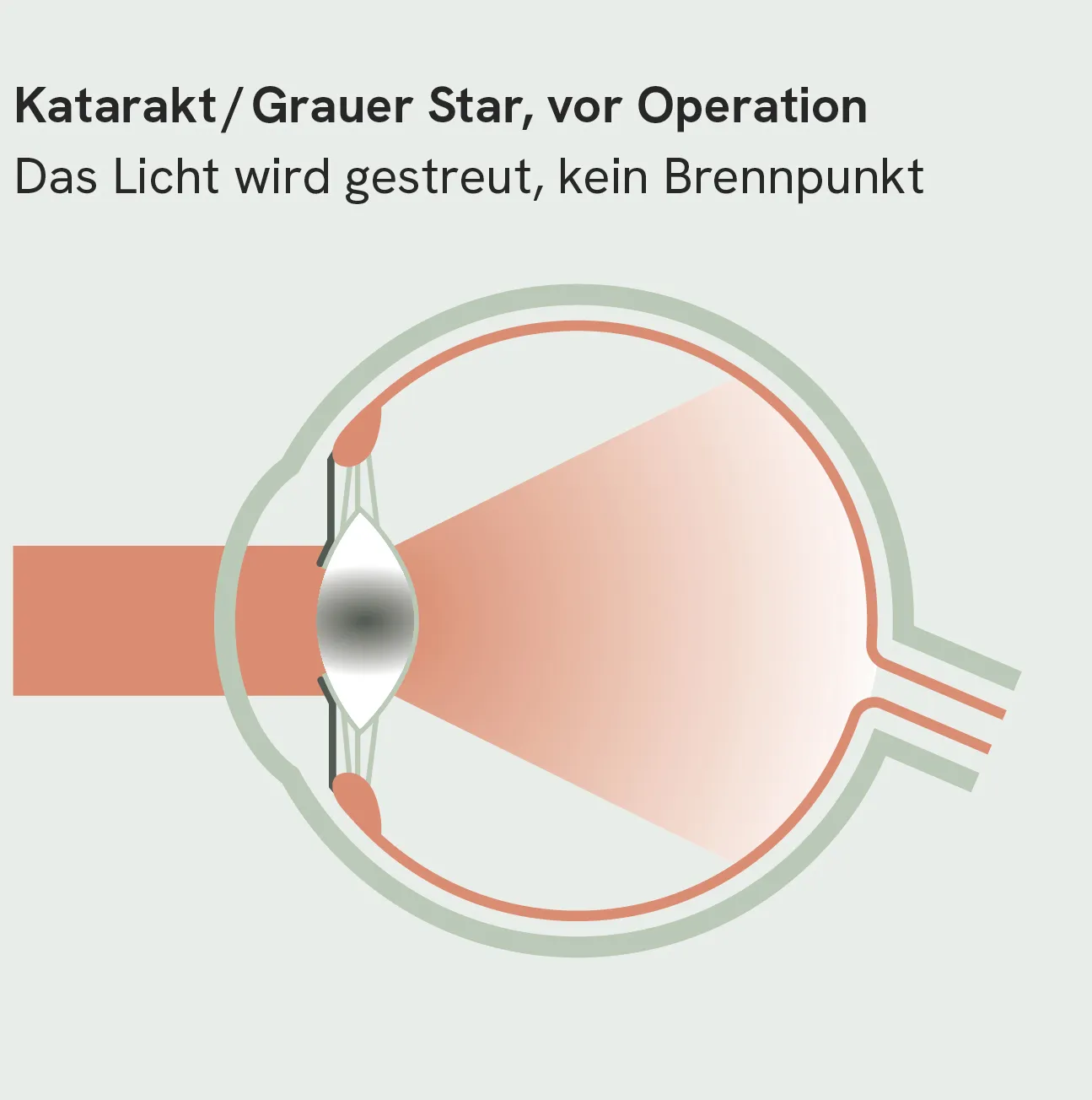 Katarakt, Grauer Star, vor Operation