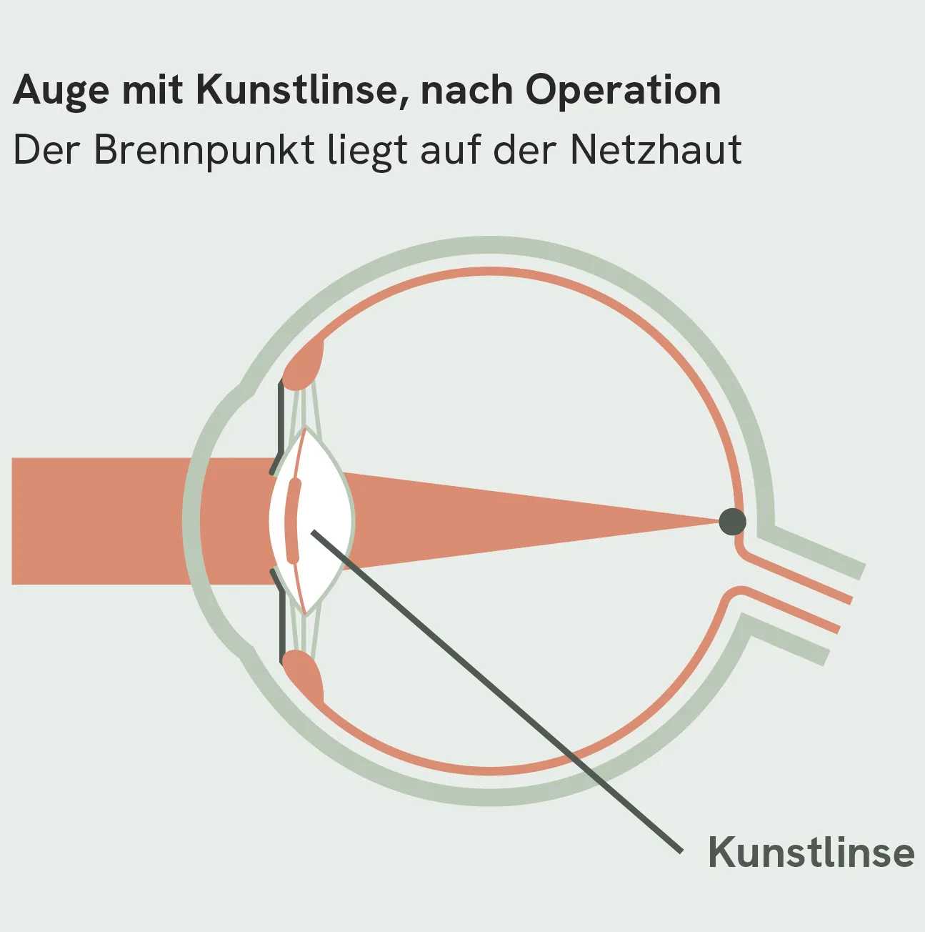 Katarakt, Grauer Star, nach Operation