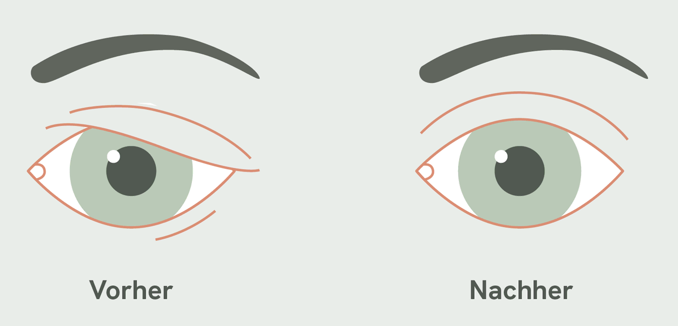 Oberlidstraffung, Schema Auge